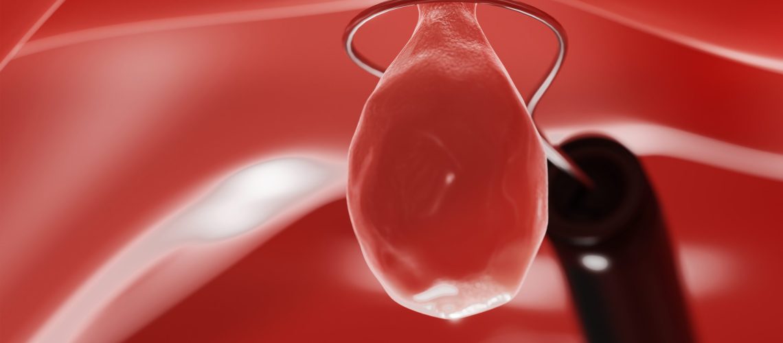Colon Polyp Removal. Endoscope inside colonoscopy for Colon polyps search. 3d render.