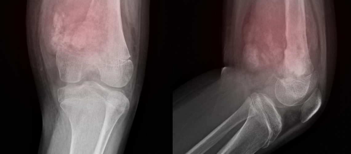 osteosarcoma